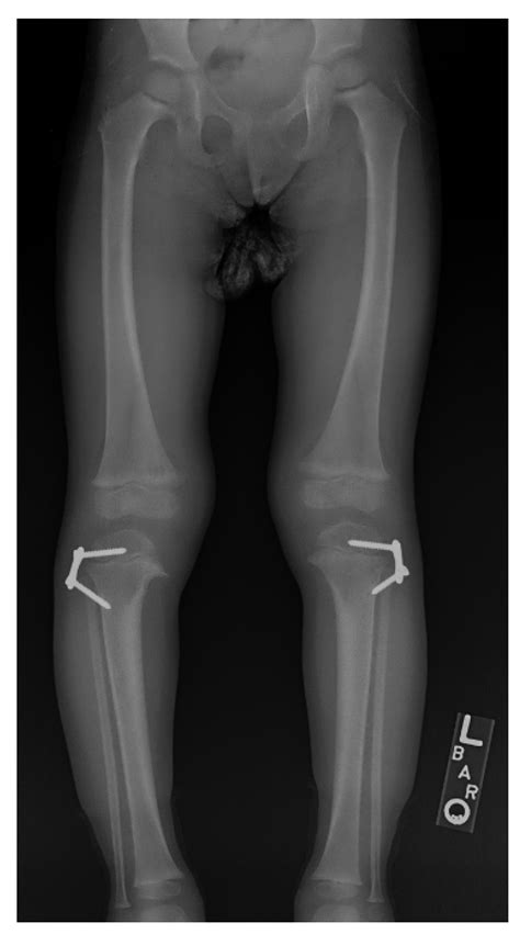 Children | Free Full-Text | Deformity Reconstruction Surgery for Blount’s Disease