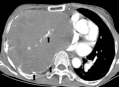 Contrast-enhanced chest CT scan reveals a huge soft-tissue attenuation ...