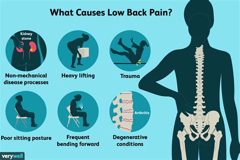 Sciatica | Lumbar Disc | Back Pain Treatment | The Pain Relief Practice