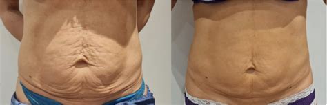 Morpheus 8 Skin Tightening - Astelas Aesthetics