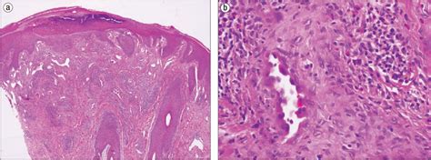 Figure 2 from Angiolymphoid hyperplasia with eosinophilia. - Semantic ...