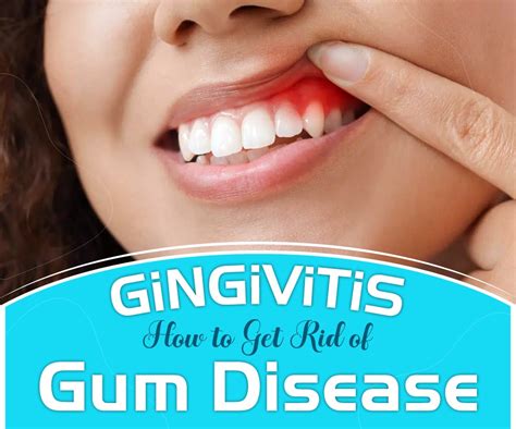 Gingivitis: How to Get Rid of Gum Disease - EVOKING MINDS