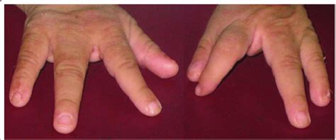 Ectrodactyly of hands. | Download Scientific Diagram