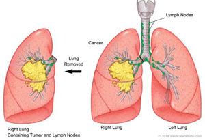 Lung Resection | RWJBarnabas Health