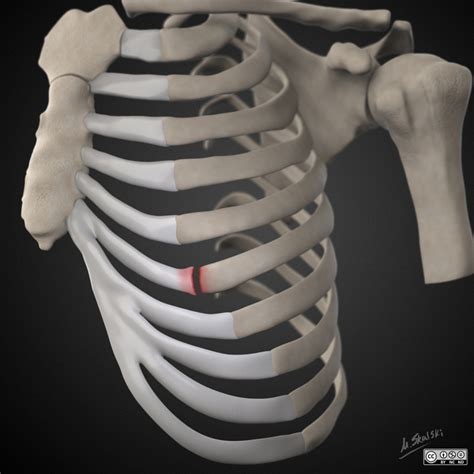 Costochondral Junction Syndrome