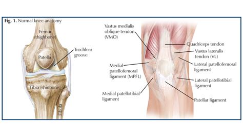 Traumatic Patellar Dislocation - Hughston Clinic