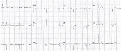 What Electrolyte Causes U Wave - cloudshareinfo