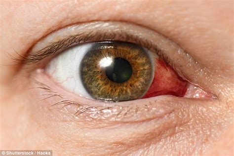 CDC warns outbreak of eye syphilis is not slowing down | Daily Mail Online