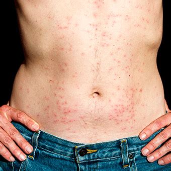 Hot Tub Rash | India| PDF | PPT| Case Reports | Symptoms | Treatment