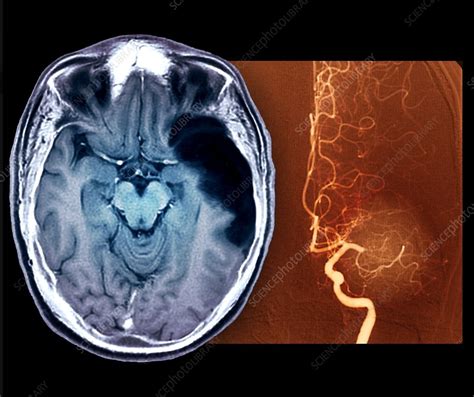 Stroke, MRI brain scan - Stock Image - C048/0716 - Science Photo Library