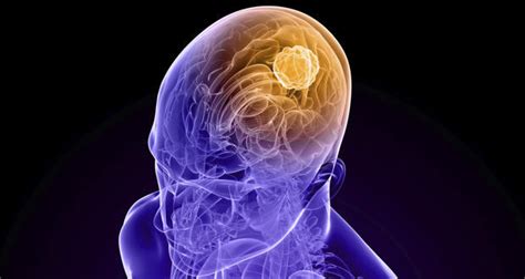 Why brain tumours are more common in men - Read Health Related Blogs, Articles & News on Health ...