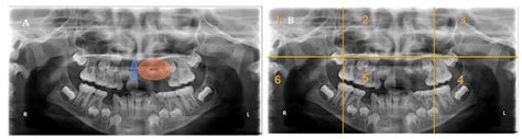 Children | Free Full-Text | Visual Analysis of Panoramic Radiographs among Pediatric Dental ...