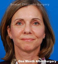 Facelift Recovery | Sunset Cosmetic Surgery