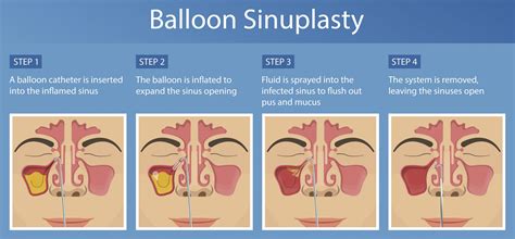 Balloon Sinus Dilation Balloon Sinuplasty - Farragut ENT