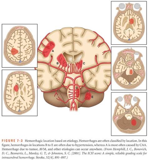 Intracerebral Hemorrhagic Stroke | Nurse Key