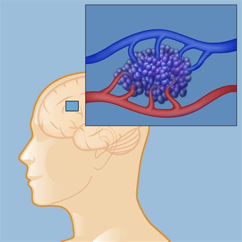 Cavernous Hemangioma Brain