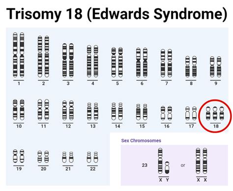 Trisomy- Definition, Causes, Types, Diagnosis, Treatments