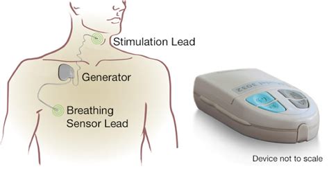 Sleep Disorders: Sleep Apnea and Upper Stimulation Therapy