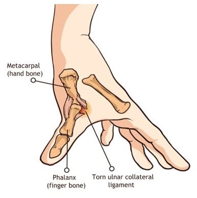 Ulnar Collateral Ligament – Boxers Thumb | Physio & More