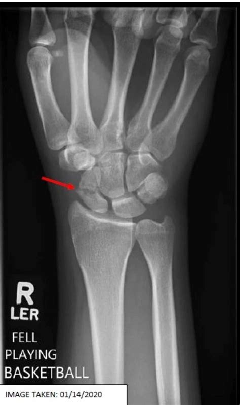 Scaphoid bone fracture - rightnetworking