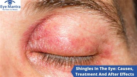 Shingles In The Eye: Causes, Treatment And After Effects