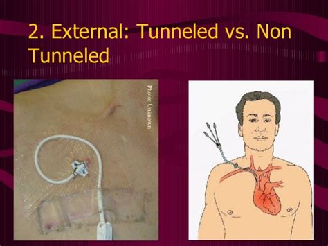 Tunneled Central Venous Catheter Placement