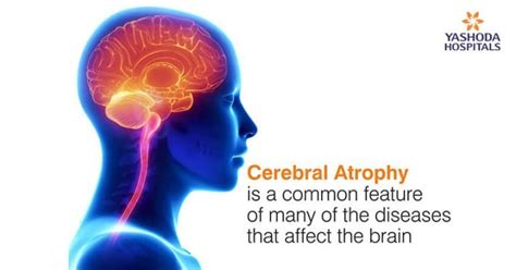 Cerebral Atrophy: Causes, Symptoms and Treatment