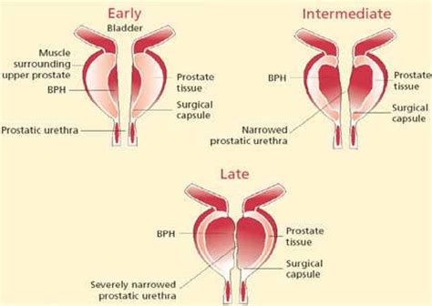 Benign Prostatic Hyperplasia