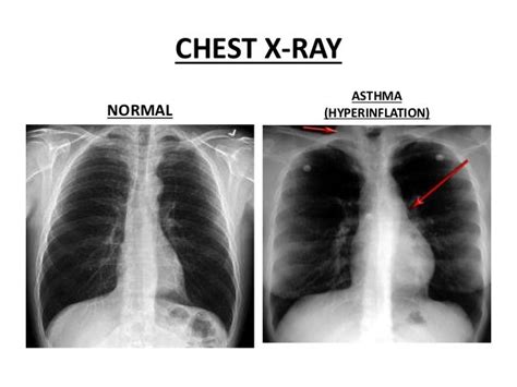 Asthma Overview