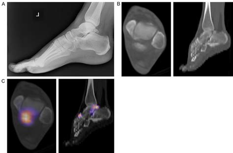 Lateral x-ray of the left ankle (A) shows wellcorticated ossicle... | Download Scientific Diagram