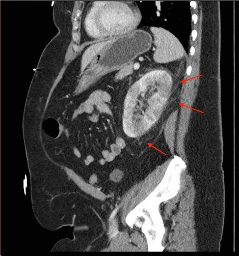 Acute Pyelonephritis with Perinephric Stranding on CT - JETem