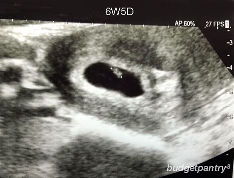 6 Week Ultrasound Heartbeat