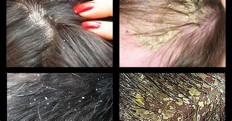 What Causes Dandruff On Scalp