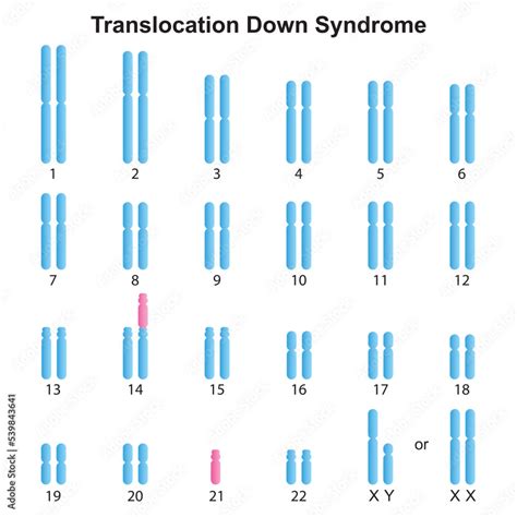 Scientific Designing of Robertsonian Translocation Down Syndrome ...