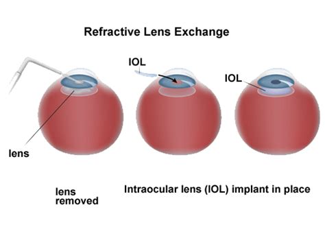 Refractive Lens Exchange (RLE) in Detroit at Fraser Eye Care