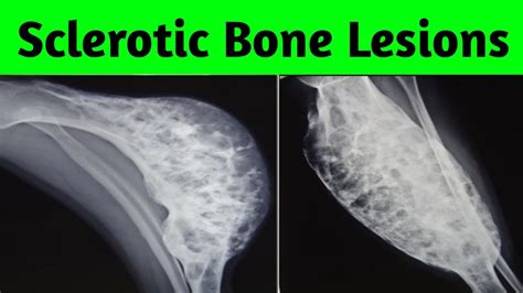 Multiple Sclerotic Bone Lesions Differential Diagnosis - YouTube