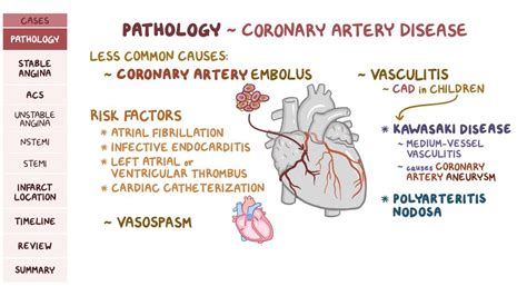 Coronary artery disease: Pathology review: Video | Osmosis