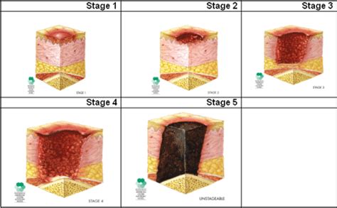 Bed Sores Stages