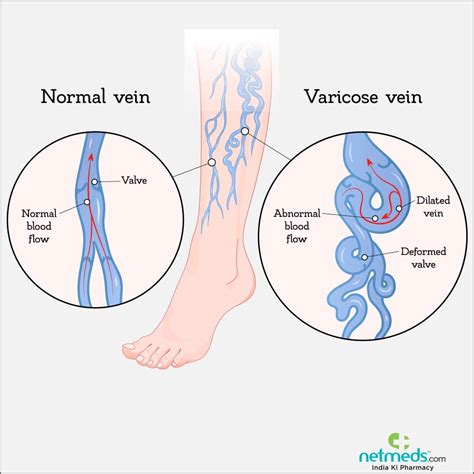 Varicose Veins: Causes, Symptoms And Treatment | Netmeds