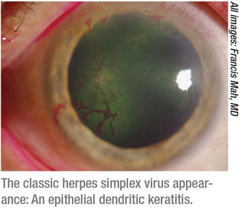 Hsv Keratitis Dendritic - Herpes Simplex Virus Hsv Disciform Keratitis ...