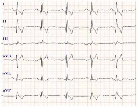 Sinus rhythm. Prolonged P waves and QRS complexes suggesting... | Download Scientific Diagram