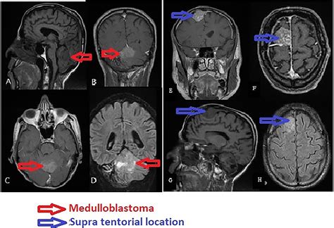 Medulloblastoma