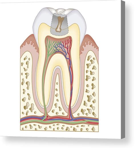 Cross Section Biomedical Illustration Of Tooth Decay Before Dental ...