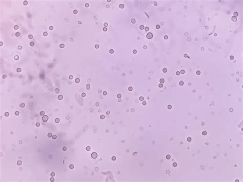 Premium Photo | RBC WBC and bacteria in urine specimen analysed by ...