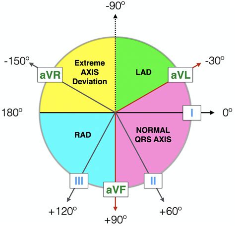 Right Axis Deviation (RAD) • LITFL • ECG Library Diagnosis