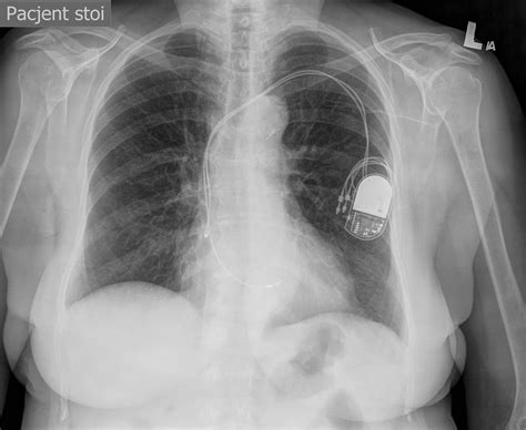 Pacemaker Chest X Ray