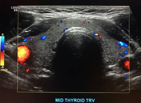 Thyroid Ultrasound Protocol – Sonographic Tendencies