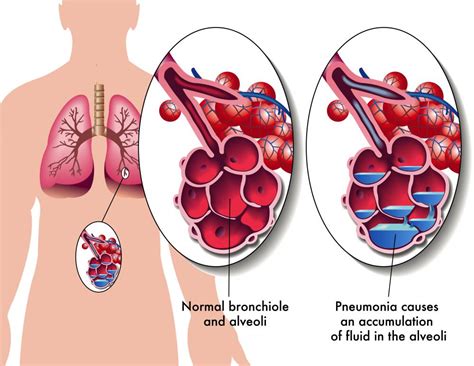 What is Bacterial Pneumonia? (with pictures)