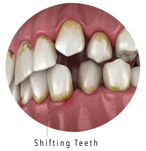 Shifting-teeth1 – Archer Dental