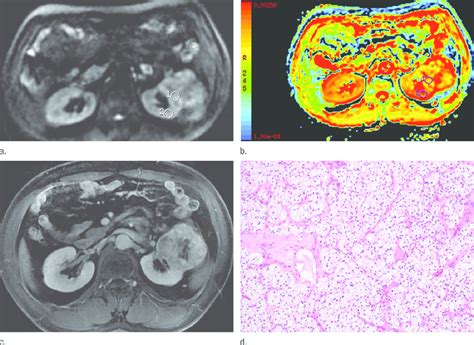 Images in 46-year-old man with clear cell RCC. (a) Transverse DW image ...